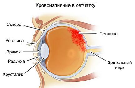 Кръвоизливи в очите причините и лечения, които правят, прогноза