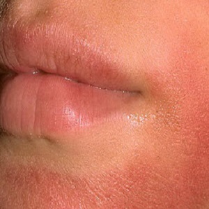 Лечение и симптоми на алергия към канела - всичко за алергии