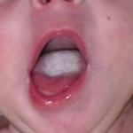Млечница в устата при кърмачета - причини, симптоми, лечение, профилактика