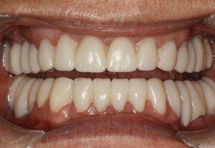 Отхвърляне на зъбни импланти - Симптоми, признаци, причини