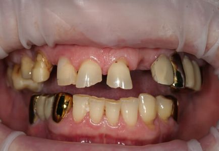 Отхвърляне на зъбни импланти - Симптоми, признаци, причини