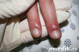 Уитлоу пръст - лечение и профилактика
