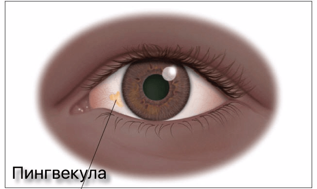 Pinguecula око причинява лечението (народната медицина, капки, лазерна) могат