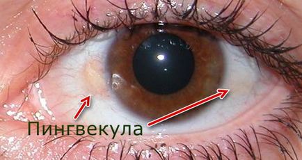 Pinguecula на окото - на образуване, формата и лечение на дегенеративни израстък на конюнктивата