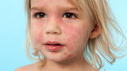Хранителна алергия в симптомите на детето, лечение, диета