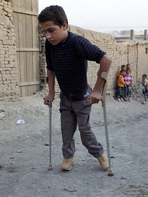 Polio случаи при децата снимка, характеристики и причини за заболяването, усложненията от полиомиелит при децата