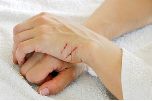 Cuts и ожулвания по ръцете на лечение на леки наранявания