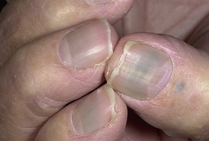 Посиняват ноктите основните причини за заболяване