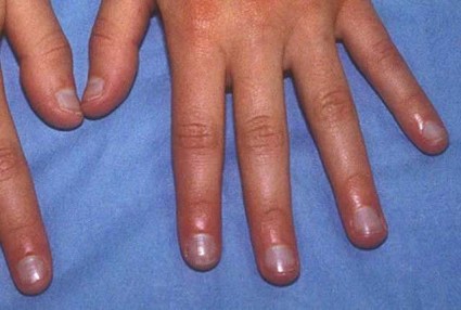 Посиняват ноктите основните причини за заболяване
