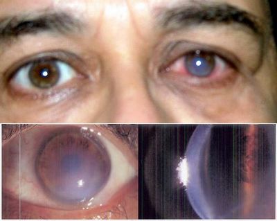 Причини и лечение на кератоконус очи