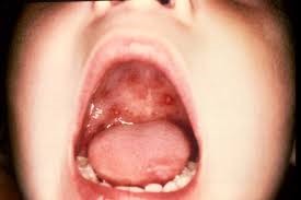 Обривът на ентеровирус инфекция при деца - описание и снимка