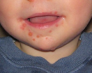 Обривът на ентеровирус инфекция при деца - описание и снимка