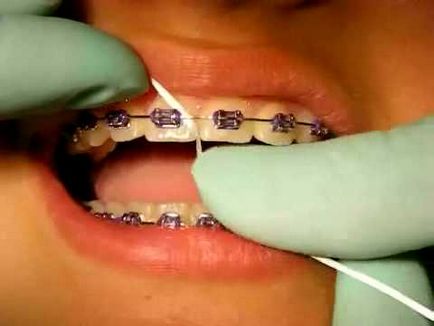 Съвети ортодонт