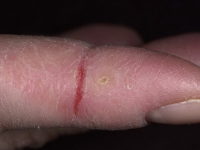 Пукнатини по ръцете и пръстите (на топки, съвети, гънките между тях) причини и лечение снимките