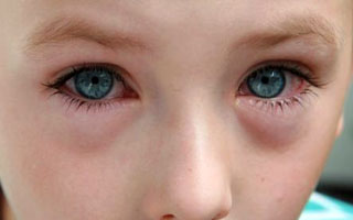 Едно дете под очите подуване - причини и лечение