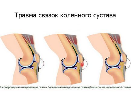лечение коляното наранявания у дома фото и видео