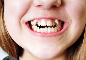 зъби подравняване без скоби в дома за възрастни и деца начини