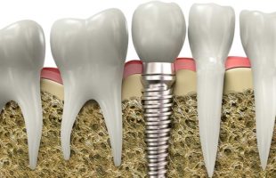 В някои случаи е отхвърляне на зъбния имплантант