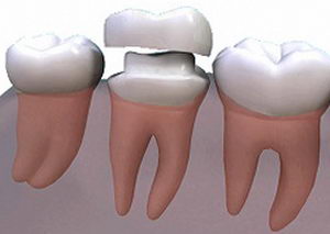 Временни корони - първата стъпка към по-здрави зъби - около ухапване корекция и тиранти