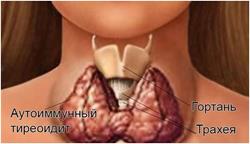 Какво е хронично автоимунно тиреоидит