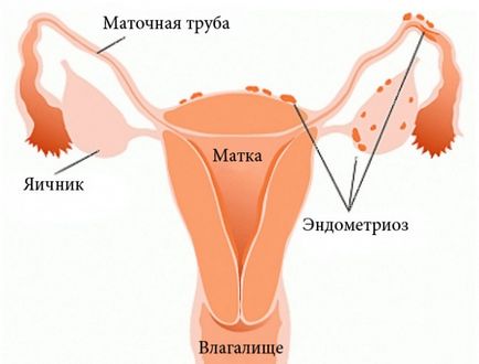 Ендометриозата на ултразвук