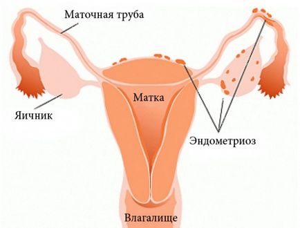 Узи ендометриоза