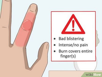 Какво да правите, когато obzhog пръст