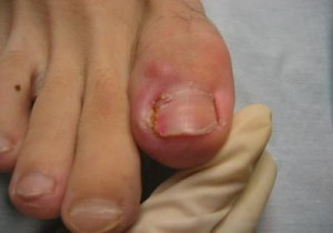 абсцес лечение на палеца