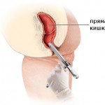 Диагностика на тънките черва