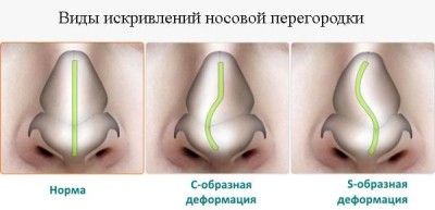 Как да се определи на носната преграда