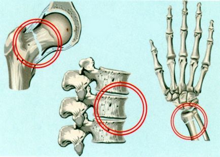 Какво е остеопороза кост