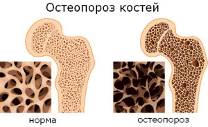 Какво е остеопороза кост
