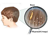 Какво е въшки на детето