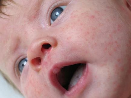 Алергии в детето Коморовски