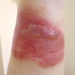 Какво е еризипел възпаление на кожата