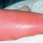 Какво е еризипел възпаление на кожата