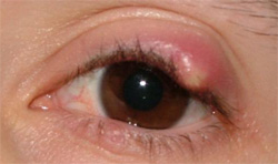 Ечемик на окото - лечение, симптоми, снимки