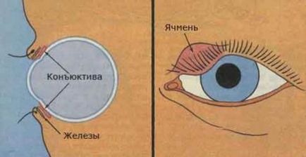 Ечемик на окото - причини, симптоми и лечение при възрастни и деца