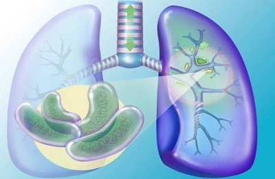 Затворената форма на туберкулоза, че е