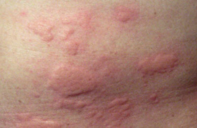 Алергии към прах