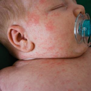 Алергичен към праха в детето, както е показано, 6 и 4 рискови фактори за основен алерген