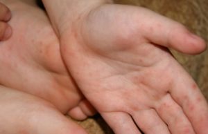 Алергични към праха в едно дете - причини, симптоми, лечение и профилактика