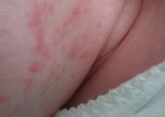 Алергия към праха в симптомите на детето