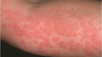 Алергия към прах за пране симптоми при деца и възрастни показват