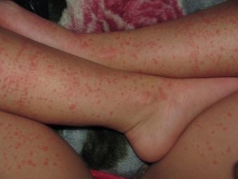 Алергия към прах за пране - симптоми, които трябва да бъдат разгледани заедно с причината