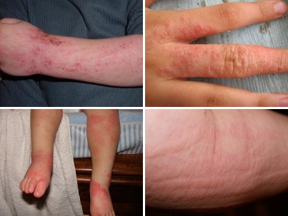 Алергия към прах за пране - симптоми, лечение, снимки, онлайн списание - алергия