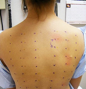 Алергия към детергенти симптоми, лечение и снимка, което се проявява алергия при възрастни
