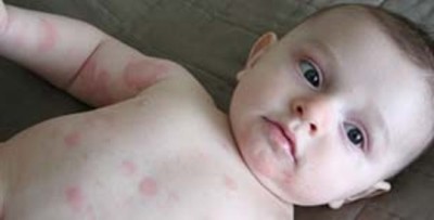 Алергия към детергентни симптоми, методи за лечение, уши бавачки правилното използване