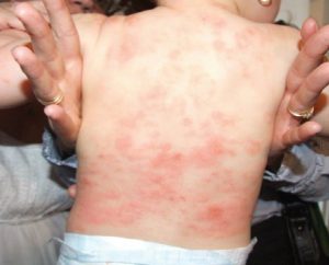 Алергия към прах за пране деца снимка, алергии при деца