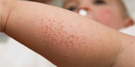 Алергия към прах за пране в детски симптоми и лечението